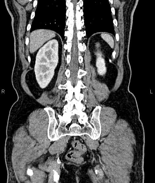 File:Cecal cancer with appendiceal mucocele (Radiopaedia 91080-108651 D 59).jpg