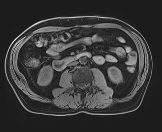 Cecal mass causing appendicitis (Radiopaedia 59207-66532 Axial T1 71).jpg
