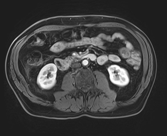 Cecal mass causing appendicitis (Radiopaedia 59207-66532 H 70).jpg