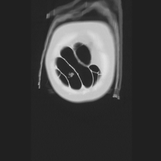 Cecal volvulus (Radiopaedia 75378-86620 Coronal lung window 16).jpg