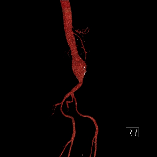 File:Celiac artery compression by the diaphragmatic crurae (Radiopaedia 31739-32666 3D CTA 4).jpg