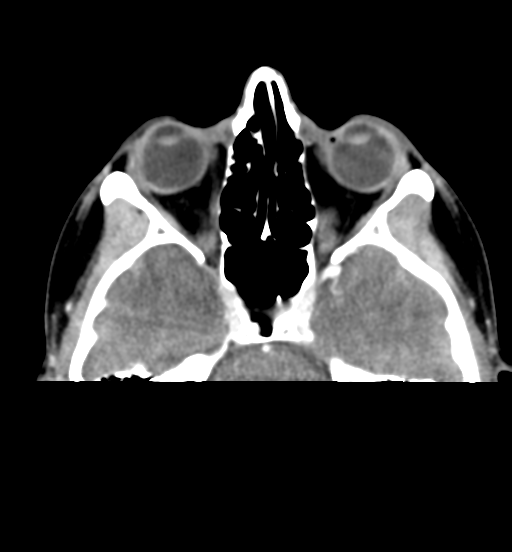 File:Cemento-ossifying fibroma (Radiopaedia 46243-50643 Axial C+ delayed 17).png