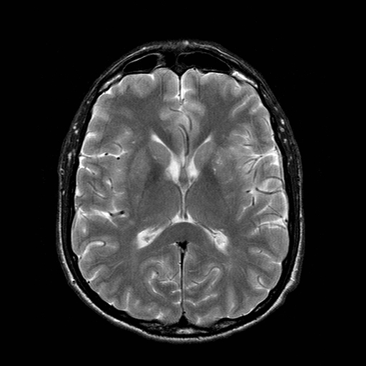 File:Central-variant posterior reversible encephalopathy syndrome (PRES) (Radiopaedia 43880-47358 Axial T2 13).jpg