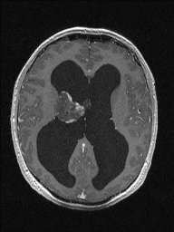 Central neurocytoma (Radiopaedia 56690-63469 Axial T1 C+ 91).jpg