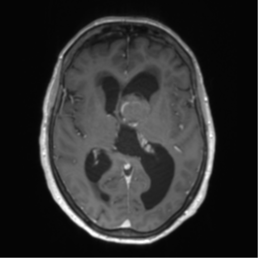 Central neurocytoma (Radiopaedia 65317-74345 Axial T1 C+ 28).png
