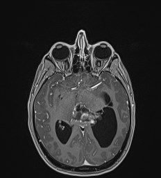 Central neurocytoma (Radiopaedia 84497-99872 Axial T1 C+ 71).jpg