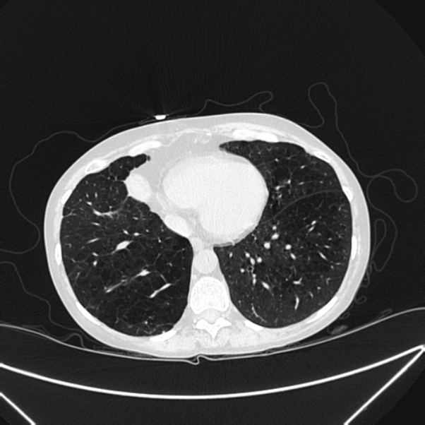 Centrilobular pulmonary emphysema (Radiopaedia 24495-24789 Axial lung window 70).jpg