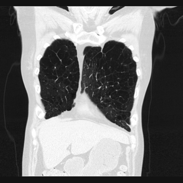 Centrilobular pulmonary emphysema (Radiopaedia 24495-24789 Coronal lung window 12).jpg