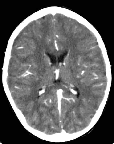 Cerebellar abscess (Radiopaedia 73727-84527 Axial C+ 49).jpg