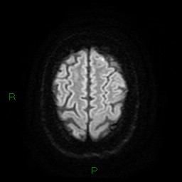 Cerebellar abscess (Radiopaedia 78135-90678 Axial DWI 25).jpg