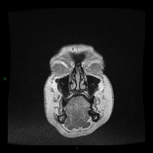 Cerebellar abscess (Radiopaedia 78135-90678 Coronal T1 C+ 1).jpg