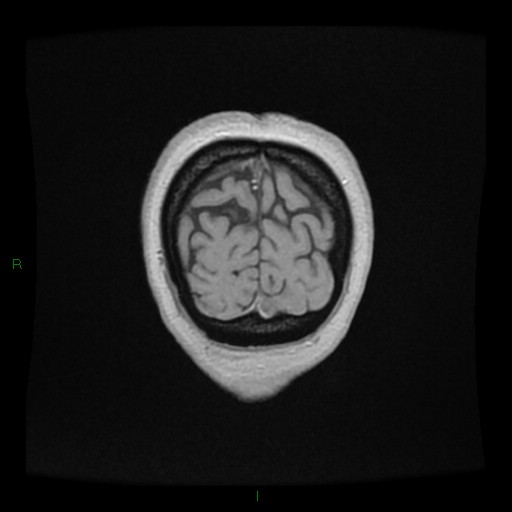 Cerebellar abscess (Radiopaedia 78135-90678 Coronal T1 C+ 160).jpg