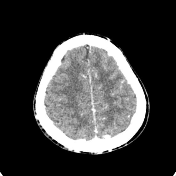 Cerebellar abscess secondary to mastoiditis (Radiopaedia 26284-26412 Axial C+ delayed 129).jpg