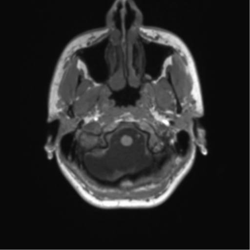 File:Cerebellar agenesis with hypoplastic pons (pontocerebellar hypoplasia) (Radiopaedia 57224-64138 Axial T1 11).png