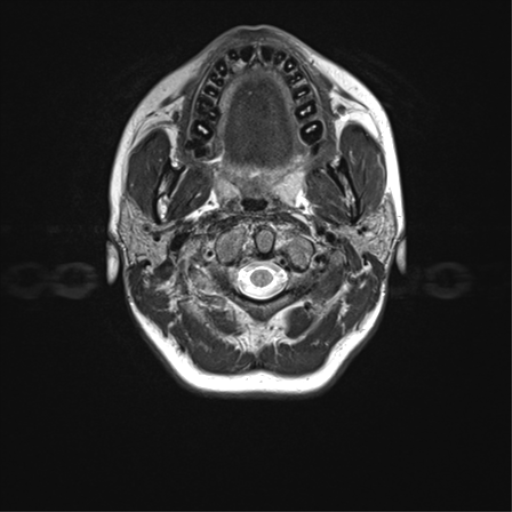 File:Cerebellar agenesis with hypoplastic pons (pontocerebellar hypoplasia) (Radiopaedia 57224-64138 Axial T2 1).png