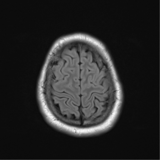 File:Cerebellar hemangioblastomas and pituitary adenoma (Radiopaedia 85490-101176 Axial FLAIR 25).png