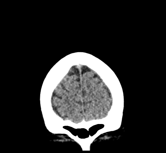 Cerebellar metastases - colorectal adenocarcinoma (Radiopaedia 40947-43652 Coronal non-contrast 15).png