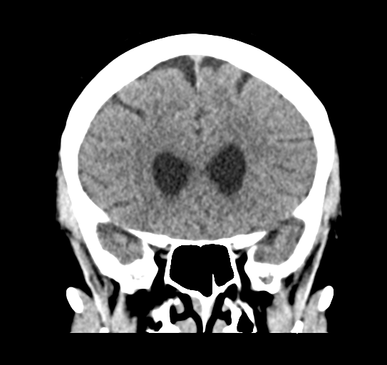 File:Cerebellar metastasis (Radiopaedia 54578-60812 Coronal non-contrast 18).png