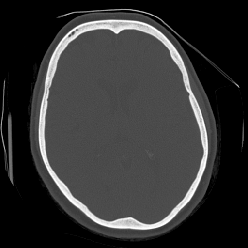 Cerebellar metastasis (cystic appearance) (Radiopaedia 41395-44258 Axial bone window 38).png