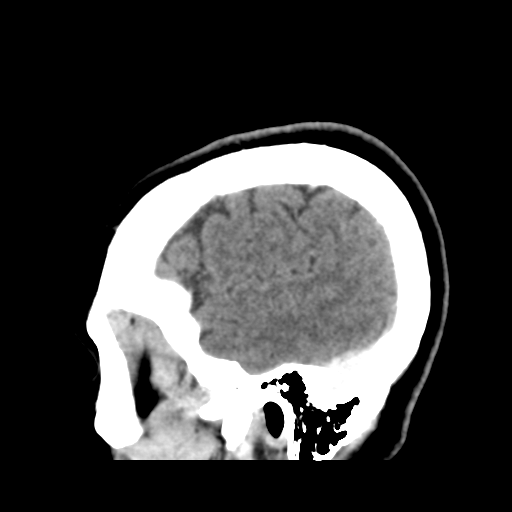 File:Cerebellar metastasis (cystic appearance) (Radiopaedia 41395-44258 F 44).png