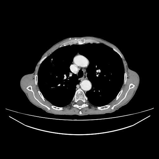 File:Cerebellar metastasis - lung tumor (Radiopaedia 69317-79150 A 12).jpg