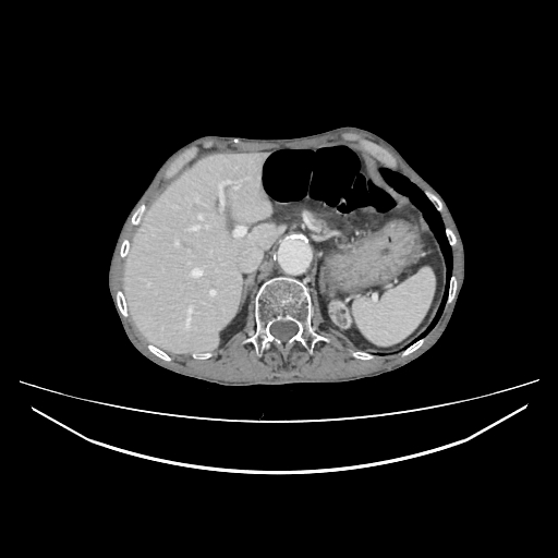 File:Cerebellar metastasis - lung tumor (Radiopaedia 69317-79150 A 36).jpg