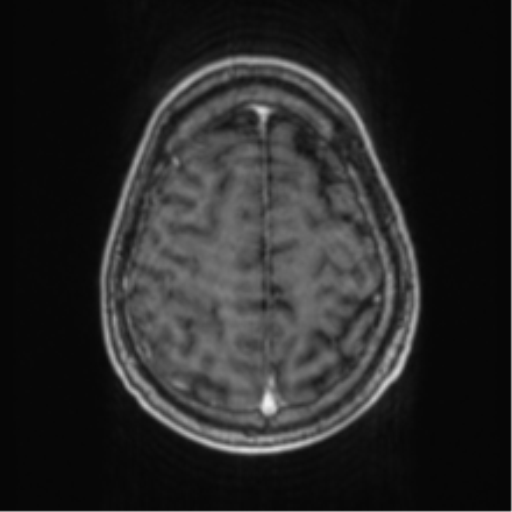 Cerebellar metastasis from lung adenocarcinoma (Radiopaedia 86690-102829 Axial T1 C+ 65).png