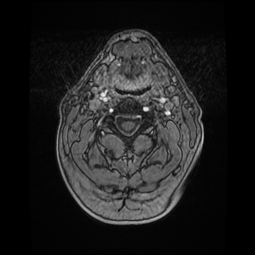 File:Cerebellar metastasis of pulmonary adenocarcinoma, cavernous venous malformation, and developmental venous anomaly (Radiopaedia 85827-101661 Axial T1 C+ 2).jpg