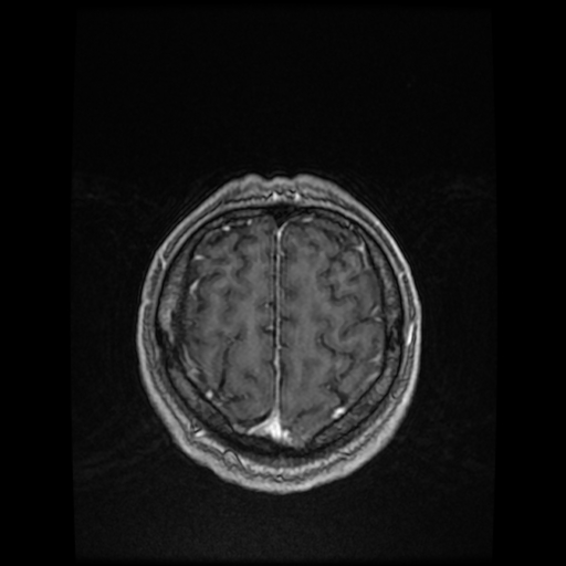 Cerebellar metastasis of pulmonary adenocarcinoma, cavernous venous malformation, and developmental venous anomaly (Radiopaedia 85827-101661 Axial T1 C+ 78).jpg