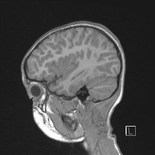 Cerebellar stroke (Radiopaedia 32202-33150 Sagittal T1 C+ 40).png