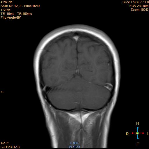 File:Cerebellopontine angle meningioma (Radiopaedia 22488-22525 Coronal T1 C+ 15).jpg