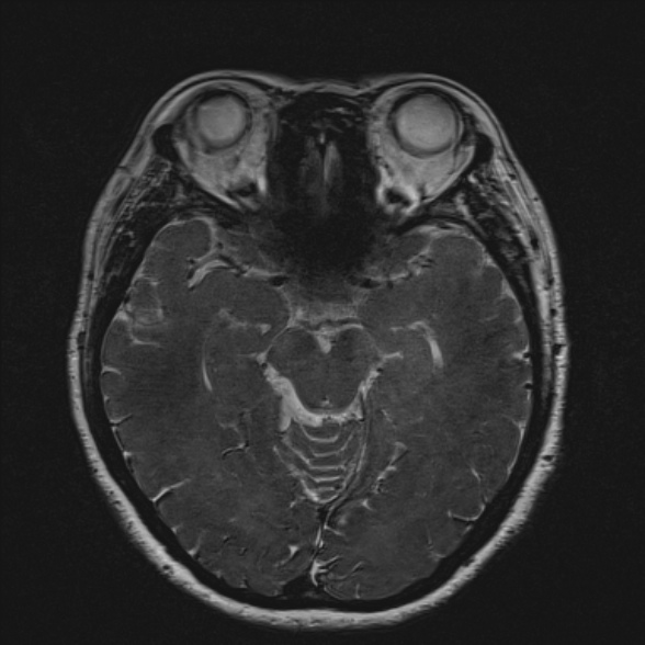 Cerebellopontine angle meningioma (Radiopaedia 53561-59591 Axial 3D volume T2 102).jpg
