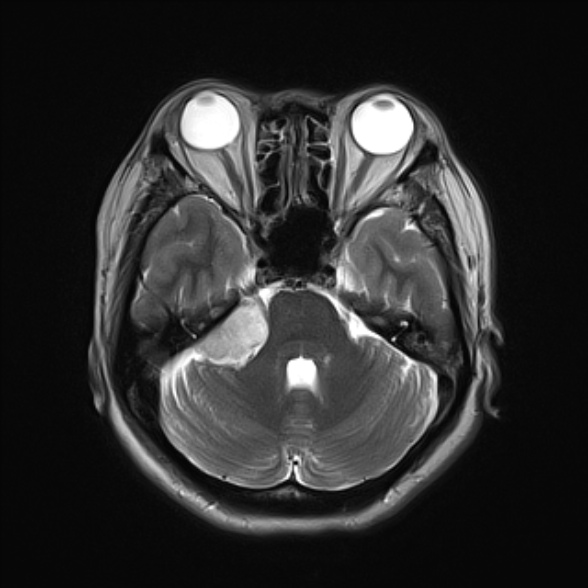 File:Cerebellopontine angle meningioma (Radiopaedia 53561-59591 Axial T2 8).jpg