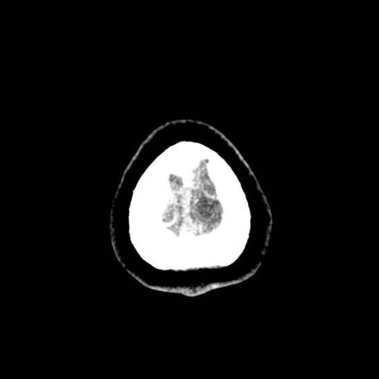 Cerebellopontine angle meningioma (Radiopaedia 53561-59592 Axial non-contrast 68).jpg