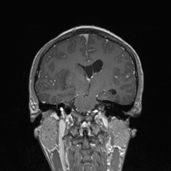 Cerebral abscess (Radiopaedia 24212-24478 Coronal T1 C+ 114).jpg