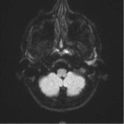 Cerebral abscess (Radiopaedia 60342-68009 Axial DWI 40).png