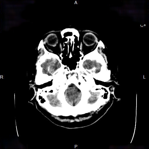 File:Cerebral abscess (Radiopaedia 7606-8432 Axial C+ delayed 1).jpg