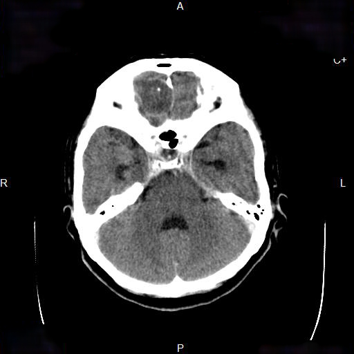 File:Cerebral abscess (Radiopaedia 7606-8432 Axial C+ delayed 4).jpg