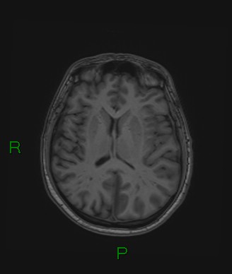 Cerebral abscess and subdural empyema (Radiopaedia 84436-99779 Axial T1 39).jpg