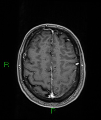 Cerebral abscess and subdural empyema (Radiopaedia 84436-99779 Axial T1 C+ 22).jpg