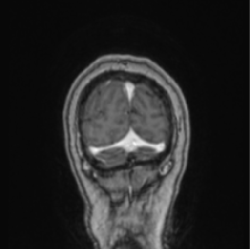 Cerebral abscess from pulmonary arteriovenous malformation (Radiopaedia 86275-102291 L 12).png