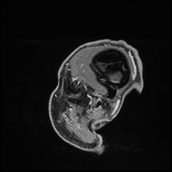 Cerebral abscess with ventriculitis (Radiopaedia 78965-91878 Sagittal T1 C+ 168).jpg