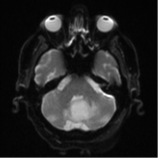 Cerebral abscesses- medically managed (Radiopaedia 45183-49179 Axial DWI 8).png
