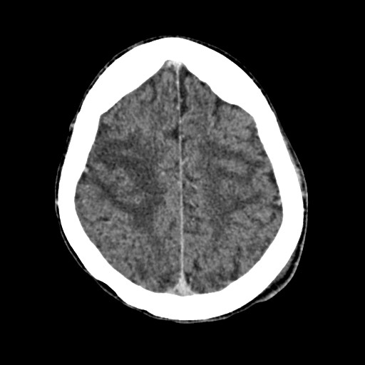 Cerebral amyloid angiopathy-related inflammation (Radiopaedia 74836-85848 Axial non-contrast 46).jpg