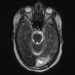 File:Cerebral amyloid angiopathy (Radiopaedia 29129-29518 Axial T2 7).jpg