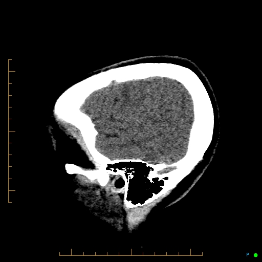 Cerebral arteriovenous malformation (AVM) (Radiopaedia 78162-90706 A 12).jpg