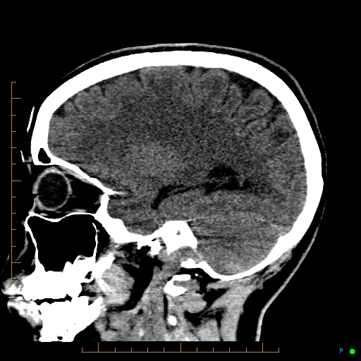 Cerebral arteriovenous malformation (AVM) (Radiopaedia 78162-90706 A 53).jpg