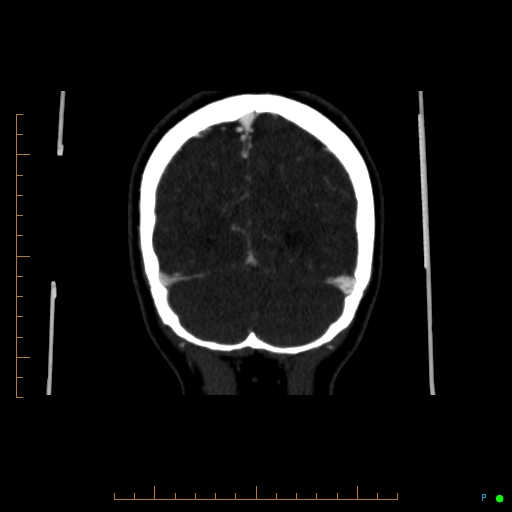 Cerebral arteriovenous malformation (AVM) (Radiopaedia 78162-90706 Coronal CTA 22).jpg