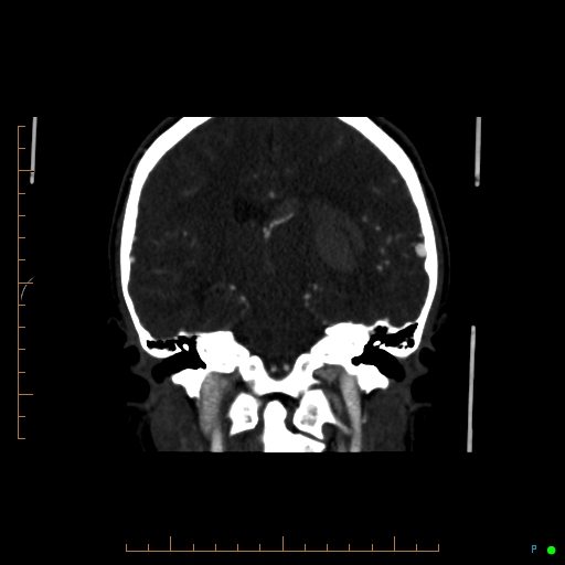 Cerebral arteriovenous malformation (AVM) (Radiopaedia 78162-90706 Coronal CTA 48).jpg