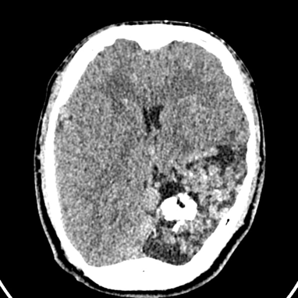 File:Cerebral arteriovenous malformation (Radiopaedia 37182-39012 Axial non-contrast 26).jpg